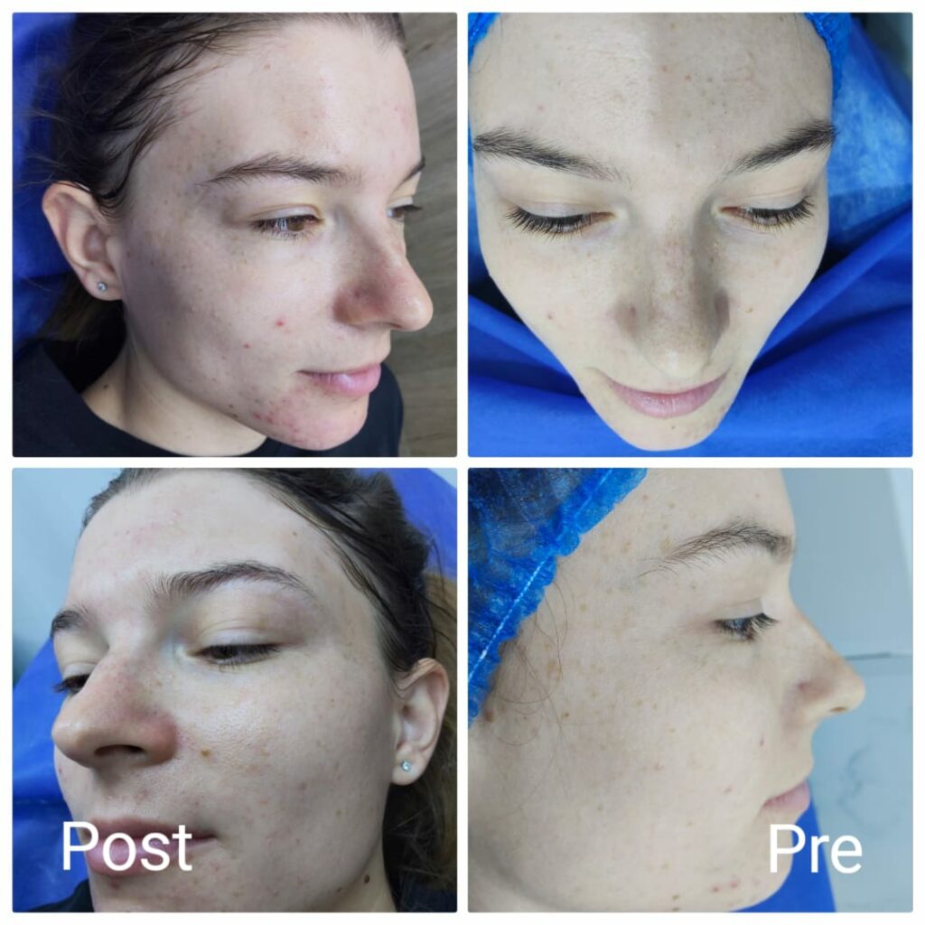 Laser skin cleaning before and after
